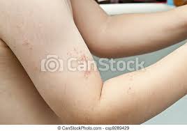 Sjukdomen karaktäriseras av en unilateral blåsbildning i huden som utbreder sig över ett dermatom, oftast thorakalt, men kan uppstå på alla delar av kroppen. Arm Herpes Barn Herpes Orsakat Blasor Hand Zoster Arm Child Canstock