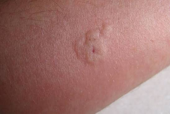 What Does a Bee Sting Look Like? | The Natural Patch Co