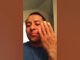 Encontrando cura vitiligo avances 25 mayo 2019