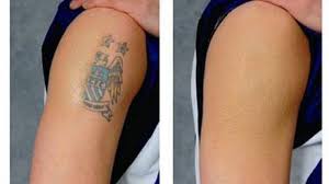 Removing a tattoo isn't as easy as it might seem. 20 Profade Tattoo Removal Cream Before And After