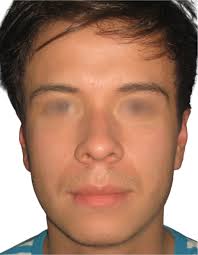 Bichectomía en Bogotá