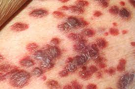 Kaposi's sarcoma was a rare and relatively harmless disease until the aids epidemic began. File Kaposi S Sarcoma Jpg Wikipedia