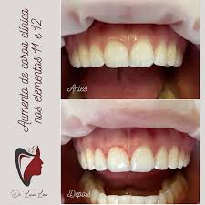 Segue o fio para dar uma olhada nos antes e depois do meia. Dr Lucas Lima Posts Facebook