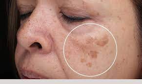 Knowing which marks and blemishes on your body sho. Dermatology Center Of Loudoun Blog Brown Spots Age Spots