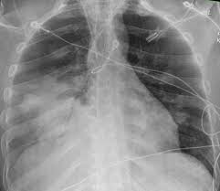 Image result for Air Bronchogram