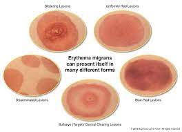 Difficulty in chewing and swallowing Does Everyone Get The Telltale Bullseye Rash Bay Area Lyme Foundation