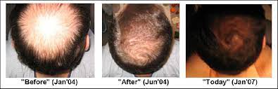 It inhibits the ability of the aromatase enzyme to convert testosterone to estrogen. Arimidex Vs Generic Anastrozole
