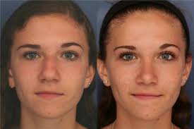 Rhinoplasty Before and After Photos by Ronald Schuster, MD; Lutherville, MD 