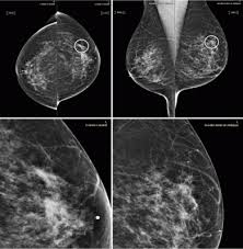 A retrospective review of 352 consecutive cts of the abdomen performed with and without iv contrast between march 2010 and october 2014 for follow. Ai Tool Improves Breast Cancer Detection On Mammography Imaging Technology News