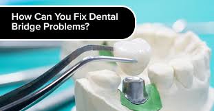 Mix a small amount of flour and water together to make a smooth, loose paste. How Can You Fix Dental Bridge Problems Oakville Place Dental
