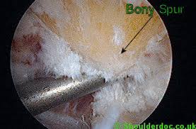 Subacromial Impingement Shoulderdoc