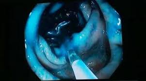 • family history of colorectal cancer syndromes (familial adenomatous polyposis and hereditary nonpolyposis colon cancer). Color Blue Detects Colon Cancer Mayo Clinic