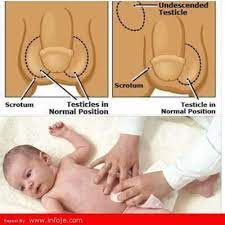 Apa itu hernia inguina (angin pasang)? Petua Untuk Menghilangkan Angin Pasang Bayi