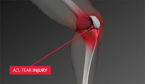 Image result for knee injury acl