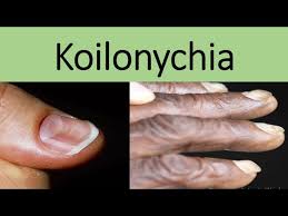 Image result for Koilonychia feet