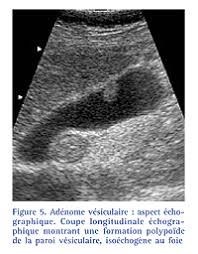 This brochure is intended to provide a general overview of a surgery. Lesions Parietales De La Vesicule Fmc Hge