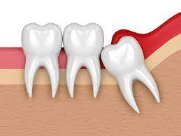 Dental practitioners require a higher cost when they have great places or online reputations. Wisdom Tooth Removal Best Laser Dental Clinic Implant Centre
