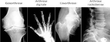 Arthrose is situated at prime locations such as hiranandani powai and khar west. Figure 9 From Etude De L Interaction Entre 14 3 3 Epsilon Et Cd13 Apn Dans La Communication Os Cartilage Au Cours De L Arthrose Semantic Scholar