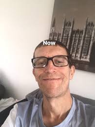 Then and now after 3 and ah half month without a single drop of Alcohol so  proud of me self was drinking for 30 years and I feel like I am a