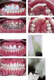 32 Cleft Orthognathic Surgery The Unilateral Cleft Lip And Palate Deformity Pocket Dentistry