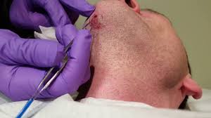 As a result, it often grows backwards and delves deep into the skin or the epithelial layer causing a serious dermatological condition. Ingrown Hairs Four Months Of Growth Youtube