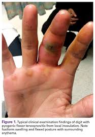 Image result for phlegmon of hand)