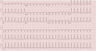Circulation Tachydysrhythmias