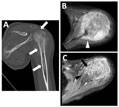 Image result for Osteosarcoma