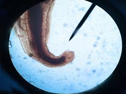 ANCILOSTOMOSE | O que é, transmissão, sintomas e tratamento