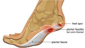 See full list on wikihow.com Heel Pain Plantar Fasciitis Specialist In Aurangabad