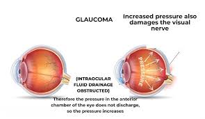 Glaucoma is a group of eye disorders that lead to progressive damage to the optic nerve. Glaucoma Eye Tension Ozel Karsiyaka Goz Hastanesi