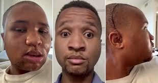 Man broke each bone in his face after falling from third-floor balcony