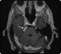 Pin On Neurology For All