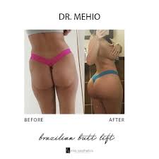 Home to sunny skies, beautiful weather, picturesque beach. Mia Aesthetics Brazilian Butt Lift By Dr Mehio Facebook
