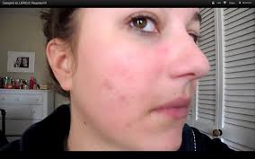 Alex and i went through quite a few bottles of sunscreen between beach vacations and atlanta heat last year, and we've had those favorites on. Allergic To Sunscreen Pictures Photos