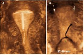A hormonal iud is also called an intrauterine device. Malposition And Displacement Of Intrauterine Devices Diagnosis Management And Prevention