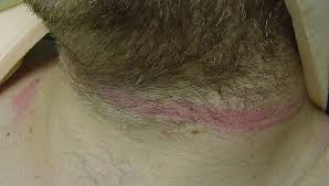 Image result for Strangulation Injury