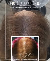 In the long run, it can even cause the death of the hair follicles. Hair Loss Thinning Treatments For Women Skulltec Smp