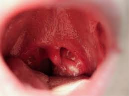 It might begin suddenly after. Pharyngitis Demonstrating Exudative Tonsillitis And An Enlarged Uvula Download Scientific Diagram