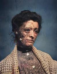 In the 1890s, before the discovery of penicillin, diseases like syphilis  were often a death sentence. One haunting photograph from that era shows a  woman with advanced syphilis—her face marked by the