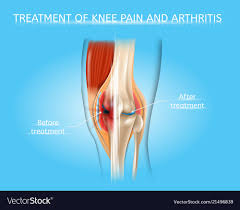 Knee Pain And Arthritis Treatment Chart
