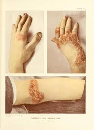 A fact sheet on the mantoux tuberculin skin test (tst), tst administration, tst interpretation, and more. Tuberculosis Verrucosa Cutis Wikipedia