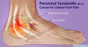 Pin Di Achilles Tendonitis Treatment