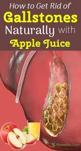 How To Get Rid Of Gallstones Naturally With Apple Juice Gallstones Applejuice Http Www Remedieslore Com How Gallbladder Cleanse Gallstones Gallbladder Diet