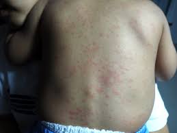 Image result for sweat rash on back baby