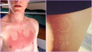 Unlike conventional ink tattoos, a sun tattoo is neither permanent nor painful. Sunburn Tattoos Are The Latest Trend On Social Media We Are Not Talking About Tan Lines Here See Viral Pics Latestly