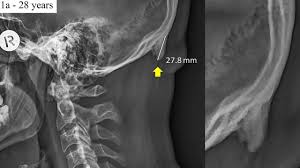 Head = the top of your body. Larger Bone Spike At Back Of Head In Young Adults Possibly Due To Poor Posture From Tech Study Says