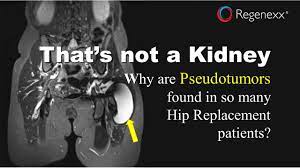 Hip Replacement Pseudotumors