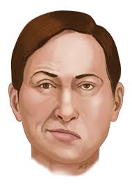 Buddy hackett had bell's palsy as a child, the lingering effects of which contributed to his distinctive slurred speech and his tendency to speak out the right side of his mouth. Patient Education Bell S Palsy Beyond The Basics Uptodate
