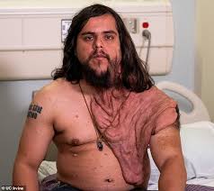 We did not find results for: Elephant Man Disease Gets Six Pounds Of Fleshy Tumors Get The Latest World News